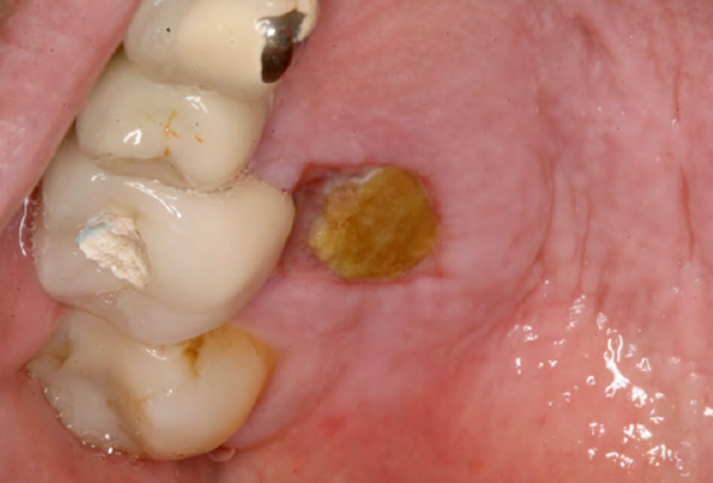 <p>cause = poor local anesthesia technique</p><p>effect = necrosis</p>