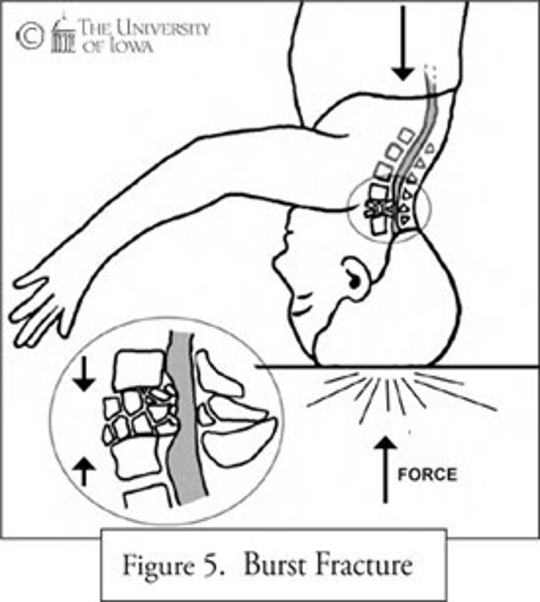 <p>Vertical compression, axial loading (primary injury)</p>