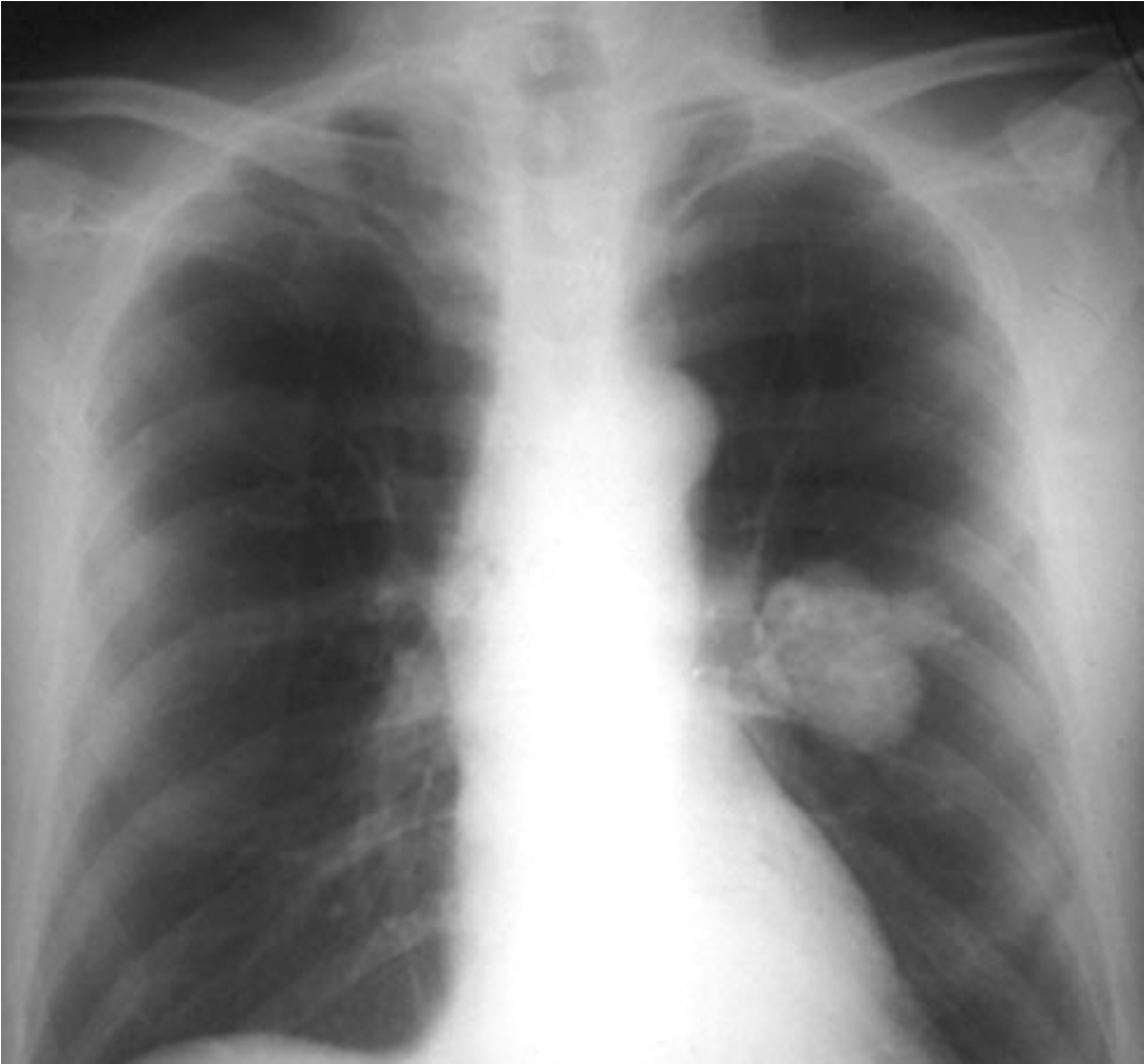 <p><strong>Lung Mass:</strong></p>
