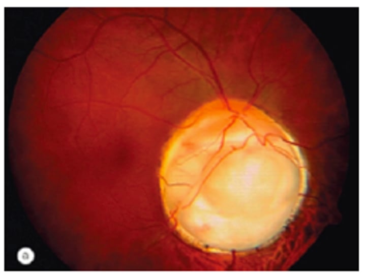 <p>incomplete closure of embryonic choroidal fissure- usually inferior<br>- associated with staphyloma or other colobomas(kidney) and Serous detachments<br>Clinic: white oval area where disc appears absent inferiorly<br>- increased blind spots, arcuates, scotoma<br>(+)APD</p>