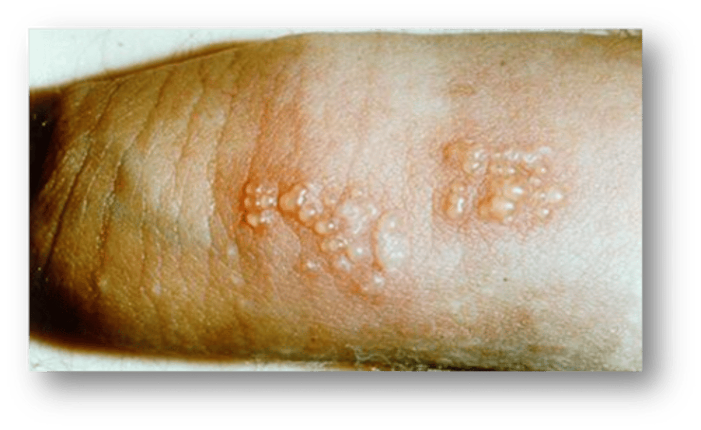 <p>Genital herpes</p>