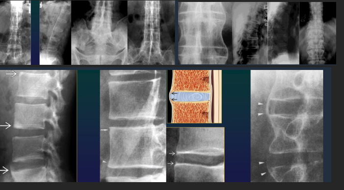 <ul><li><p>Shiny corners</p></li><li><p>Square vertebrae</p></li><li><p>Syndesmophites </p></li><li><p>Bamboo stick</p></li><li><p>Calcifications</p><ul><li><p>Interspinate</p></li><li><p>Yellow lig (tram line)</p></li></ul></li></ul><p></p>