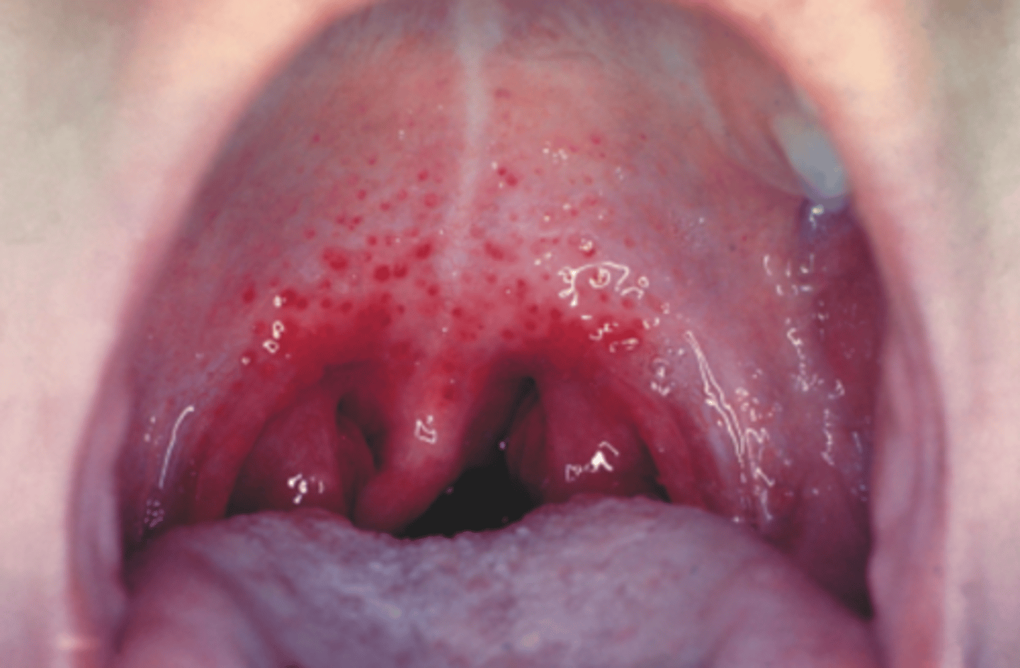 <p>atypical in general, but if concerned about connection to systemic condition, then refer</p><p>Tiny red spots caused by escape of small amount of blood</p><p>Trauma</p><p>Anemia</p><p>Leukemia</p>