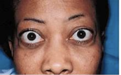 <p><span>How would you document the assessment findings of this patient’s eyes?</span></p><p></p>
