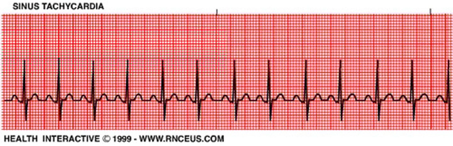 <p>100-150bpm. rhythm is normal but too fast. workload of the heart is increased while the perfusion is decreased. this is a normal response to the body's increased demand for O2</p>