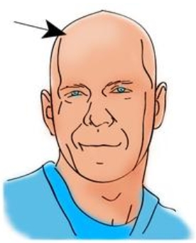 <p>People without hair on their heads are <strong>bald</strong>.</p><p><span>|bɔːld|</span></p><p>Лысый</p>