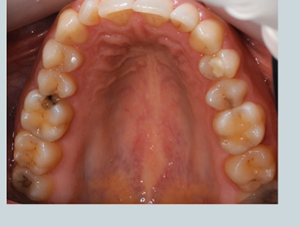 <p>lots!</p><ol><li><p>what colour is the lesion </p></li><li><p>is the pt’s oral hygiene good or is there lots of plaque present </p></li><li><p>what’s the patient doing - if anything , to keep their teeth clean?</p></li><li><p>do they use fluoride toothpaste?</p></li><li><p>do they use fluoride mouth wash?</p></li><li><p>do they use floss/interdental brushes?</p></li><li><p>do you think the patient has a normal amount of saliva or do they have a dry mouth </p></li><li><p>are there any medically relevant factors?</p></li><li><p>what is the patient’s view of their own teeth?</p></li><li><p>how is their lifestyle/commitments?</p></li><li><p>how is their diet?</p></li></ol><p></p>
