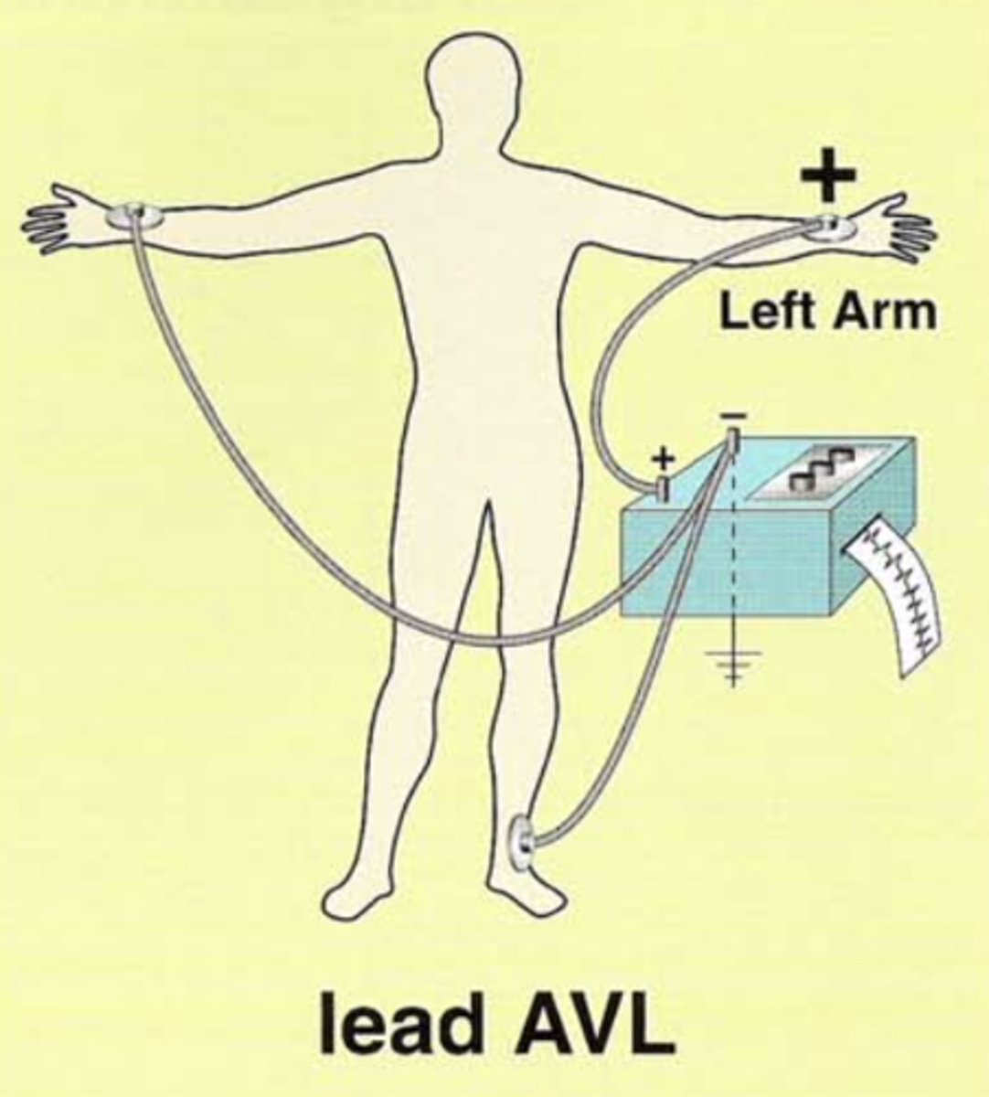 <p>Augmented/amplified, Voltage, Left arm</p><p>Left arm electrode is positive.</p><p>The remaining two are negative. </p>