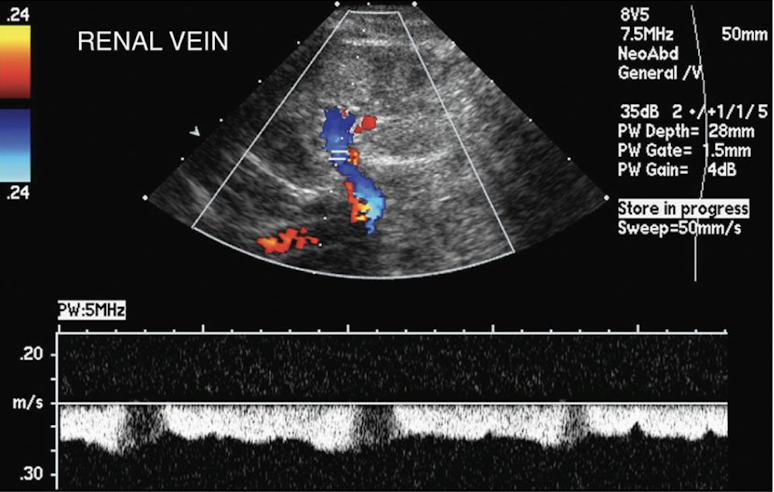 <p><u>spontaneous</u> and variable (similar to IVC)</p>