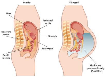 <p>Fluid accumulation in the peritoneal cavity</p>