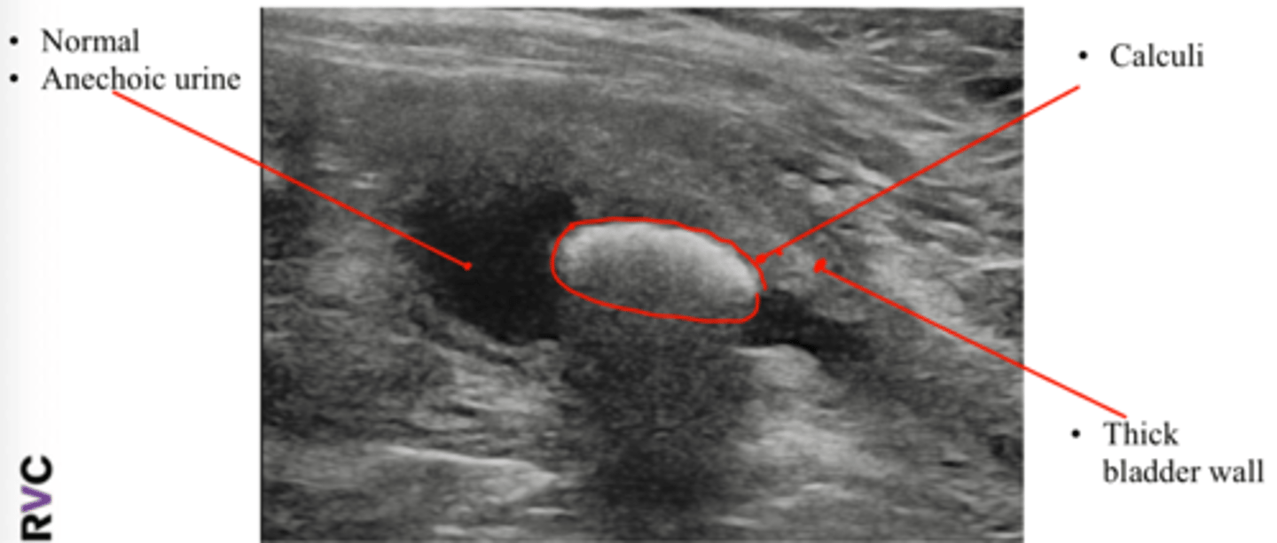 <p>Abnormal echogenicity (normal urine is anechoic)</p><p>hyperechoic shadow interface</p><p>Thickened bladder wall</p>