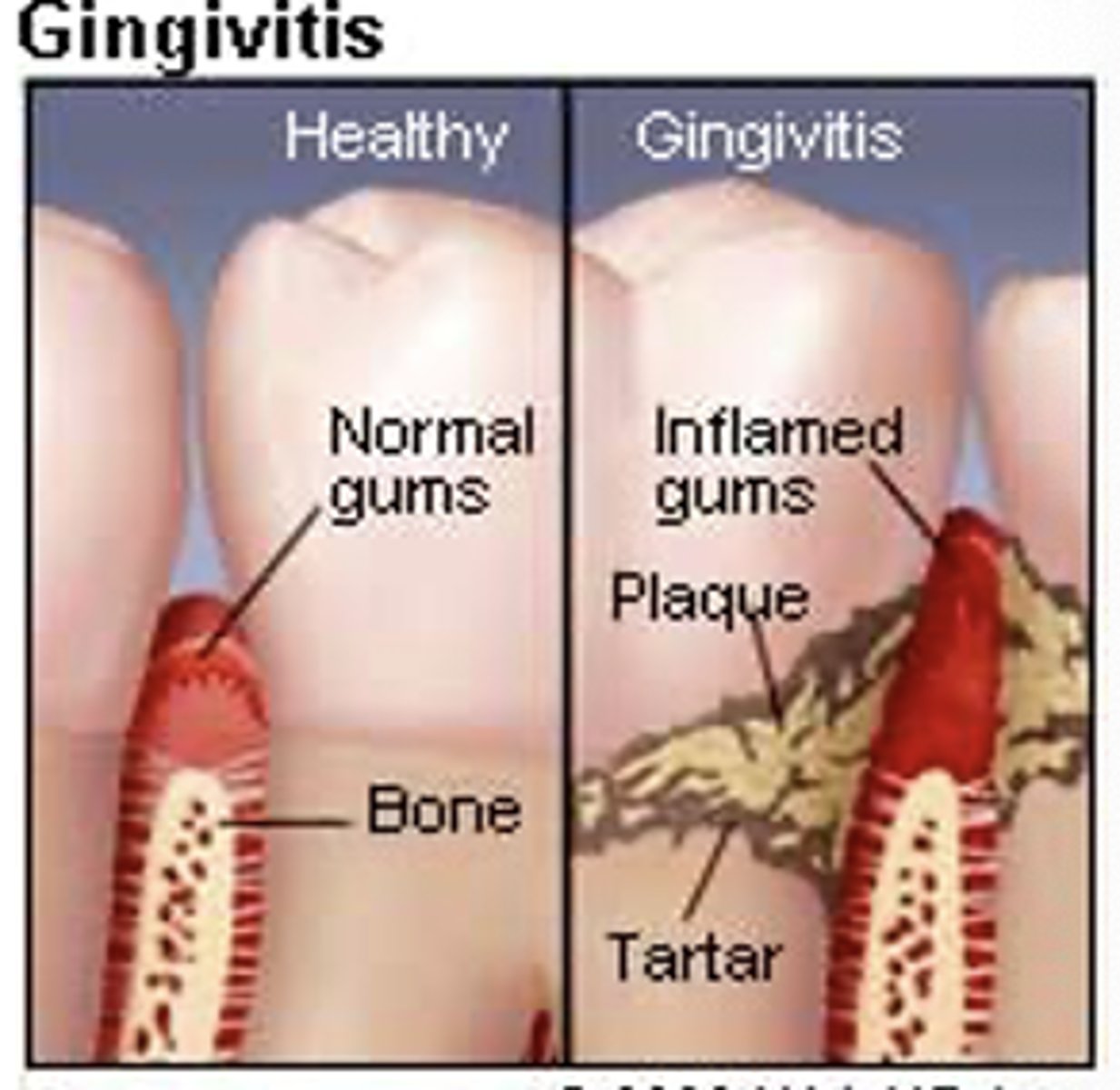 <p><strong>Early phase</strong> – <span class="bgB">gingivitis</span></p><p>–Acute and chronic inflammation</p><p>•Subgingival plaque present</p><p><span style="text-decoration:underline">•No pain, gums bleed, mild odor</span></p>