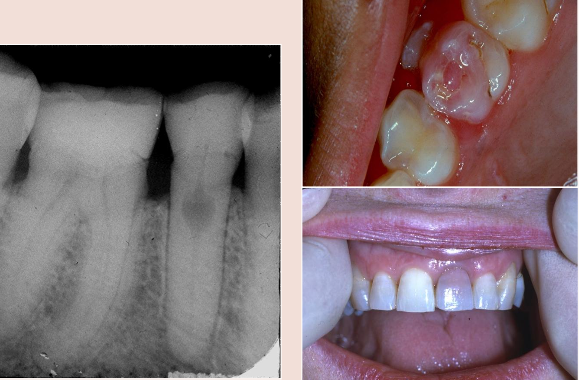 <ul><li><p>Rare</p></li><li><p>Injury to pulpal tissue </p></li><li><p>When crown is affected known as Pink tooth of mummery</p></li></ul><p></p>