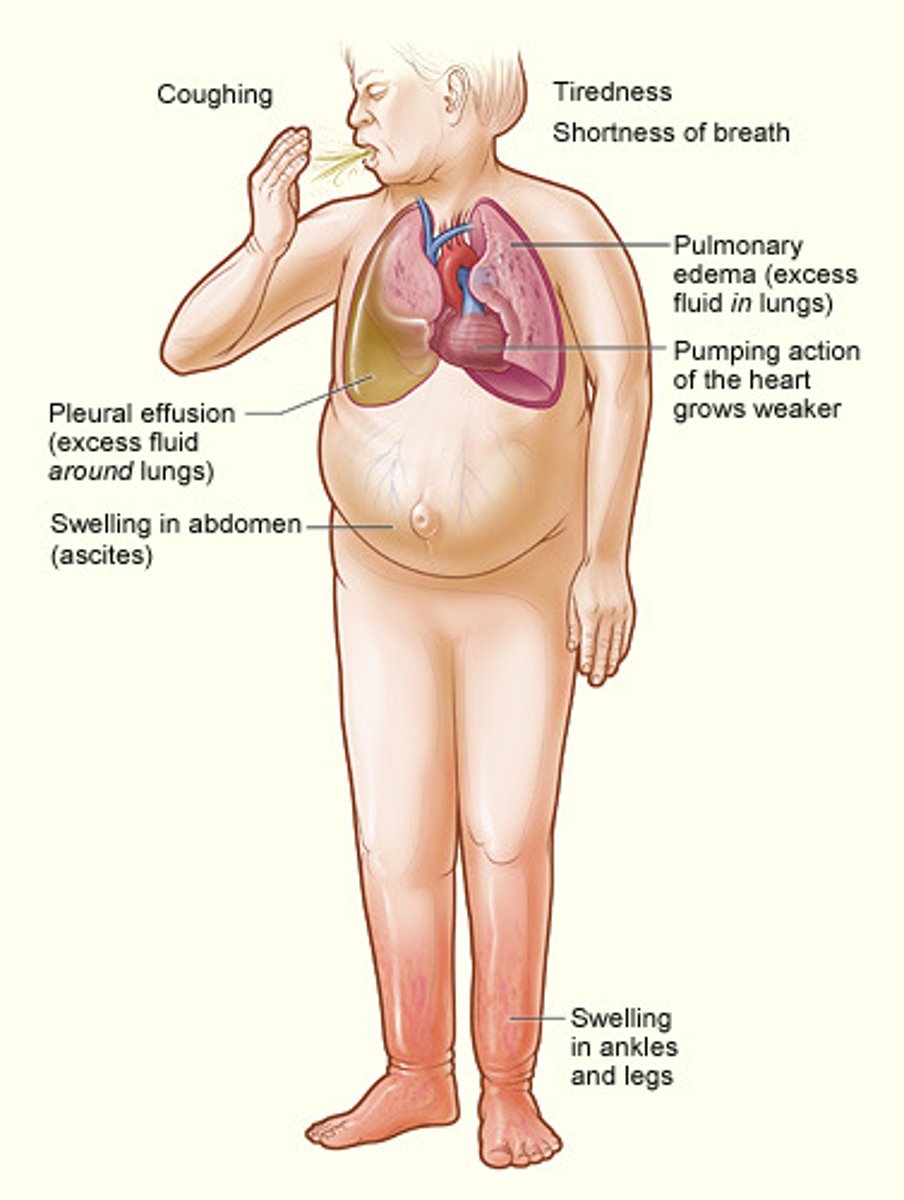 <p>A condition resulting from the heart's inability to pump out all the blood that returns to it; blood backs up in the veins leading to the heart, causing an accumulation of fluid in various parts of the body</p>