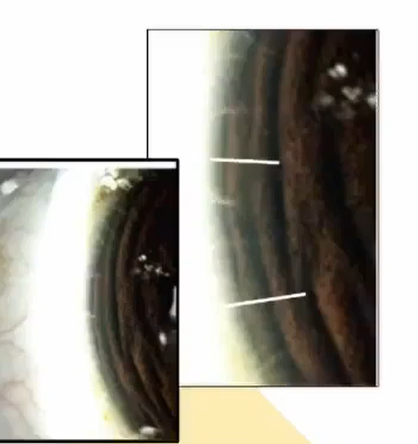 <ol><li><p>light from illumination system is focused immediately adjacent tot he structure to be examined </p></li><li><p>good for corneal nerves, corneal neovascularization</p></li><li><p>PPD to start </p></li><li><p>full beam height </p></li><li><p>wide beam angle </p></li><li><p>mod bright </p></li><li><p>moderate mag </p></li><li><p>focus light at limbus and can see corneal nerves stretching into cornea</p></li></ol><p></p>