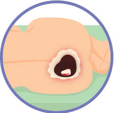 <p>what is an unstageable pressure injury?</p>
