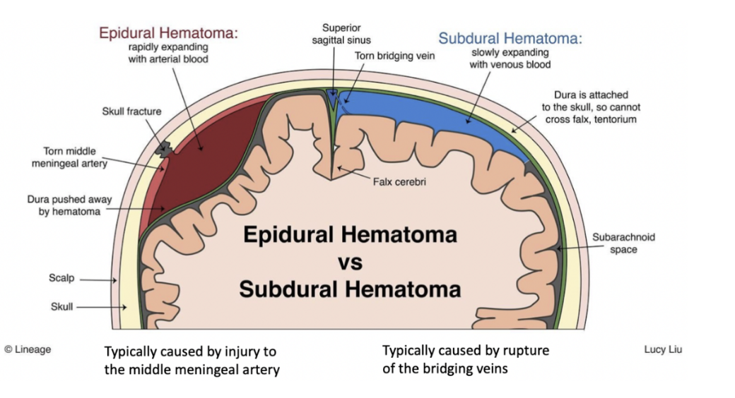 <p>Epidural/extradural hematoma —  between the bone &amp; endosteal layer of the dura mater, caused by a blow to the side of the head (probably caused by a lesion in the middle meningeal artery) </p><ul><li><p><span>Initial loss of consciousness due to the concussion</span></p><ul><li><p>Trauma to reticular formation</p></li></ul></li><li><p><span>May be followed by a lucid period of some hours (lucid interval)</span></p><ul><li><p>Can be the time in which blood starts to pool, leading to compression of the brain</p></li></ul></li><li><p><span>Onset of increasing drowsiness and headache</span></p><ul><li><p>Due to the intracranial compression </p></li></ul></li></ul>