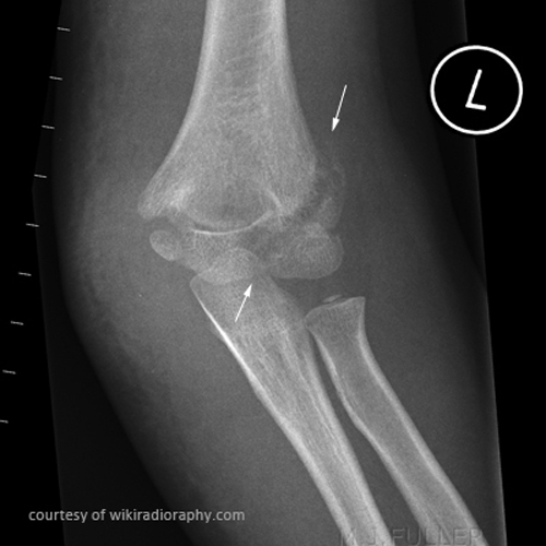 <p>Premature physeal fusion and joint deformity.</p>