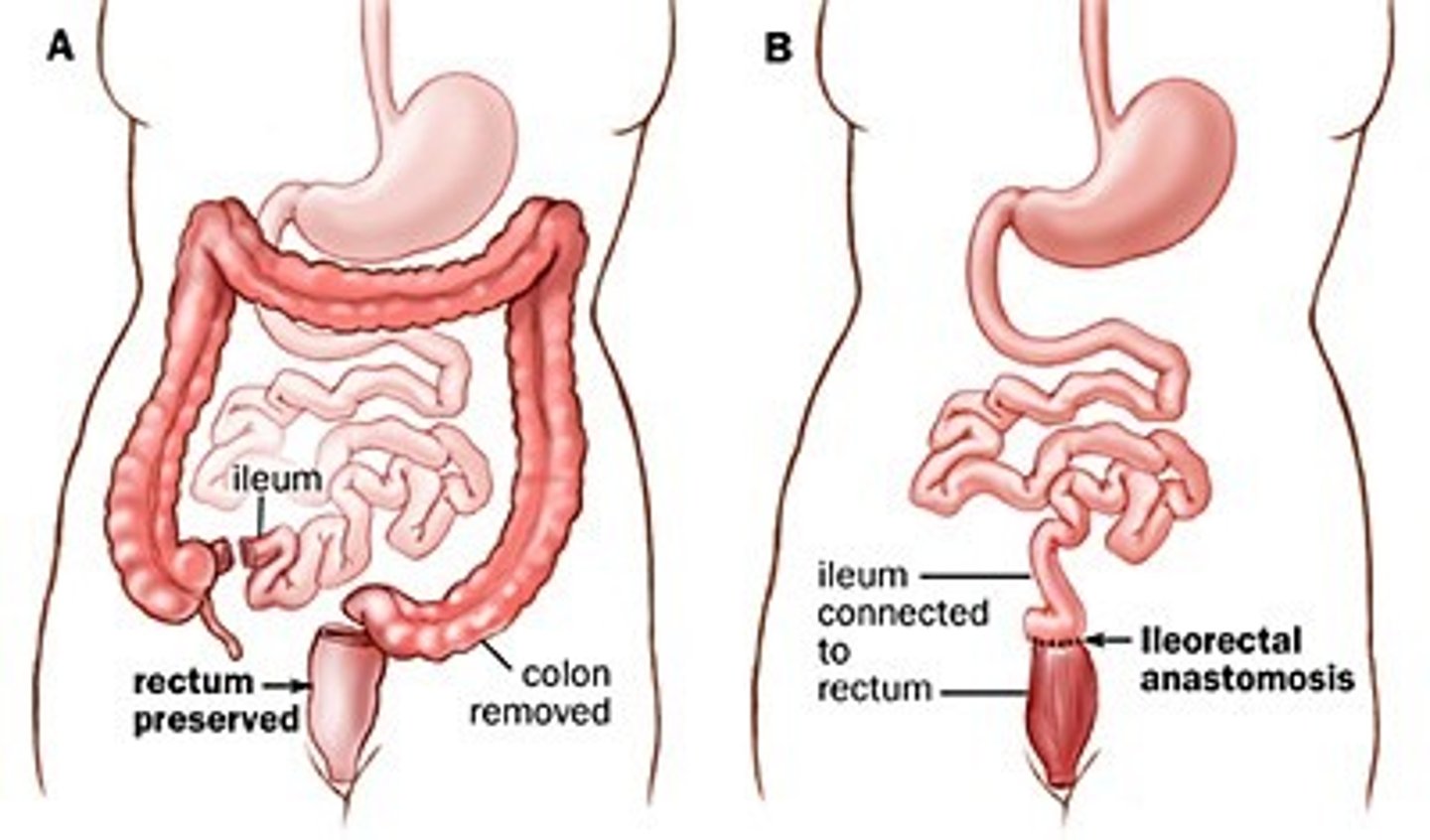 <p>-admission, consult surgery/ gastroenterology</p><p>-if pharm fails, partial or total colectomy</p>