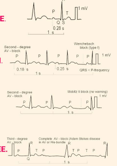 <p><strong>The Heart Block Poem</strong></p><p>-If the _<em> </em>is far from P, then you have ____ degree</p><p>-Longer, longer, longer, _____. Then you have ___________</p><p>-If some __<strong> </strong>don’t get through, then you have<strong> </strong>______ II</p><p>-If __ and Qs don’t agree, then you have ____ degree</p>