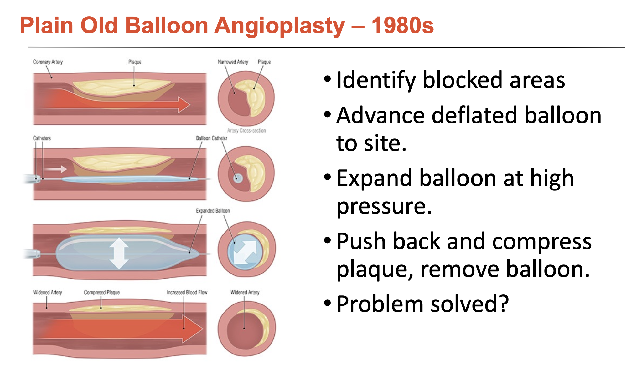 <p>Balloon angioplasty was used to identify blocked areas since angiography is hard to rely upon accurately.</p><ul><li><p>deflated balloon is advanced to lesion site → expanded at high pressure to push back and compress plaque</p></li></ul><p></p>