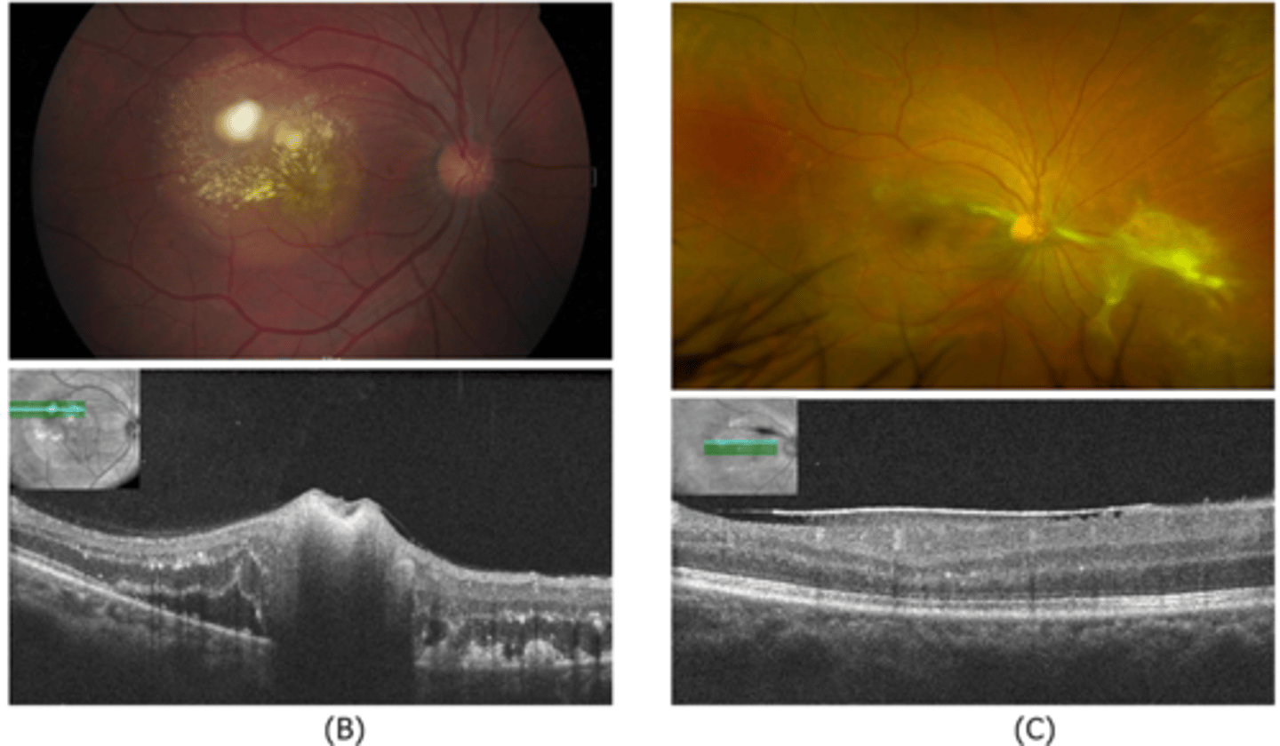 <p>recurrence = granulomas with exudates, edema</p>