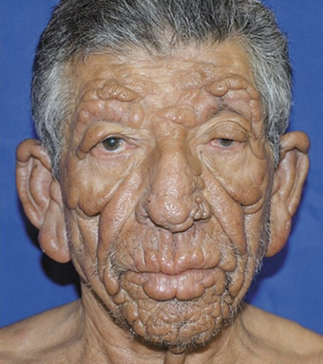 <p>Late</p><p>3 to 30</p><p>cardiovascular</p><p>Central nervous</p><p>Gummatous</p>