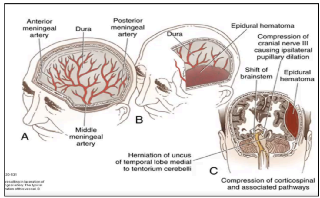 <p><strong>5 to 15% </strong>of patients with fatal head injury are:</p><ul><li><p><strong>58%</strong>: acute</p></li><li><p><strong>31%</strong>: sub-acute</p></li><li><p><strong>11%</strong>: chronic</p></li></ul><p></p>
