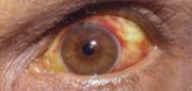 <p>Blood diffuses into tissues without a defined border</p>