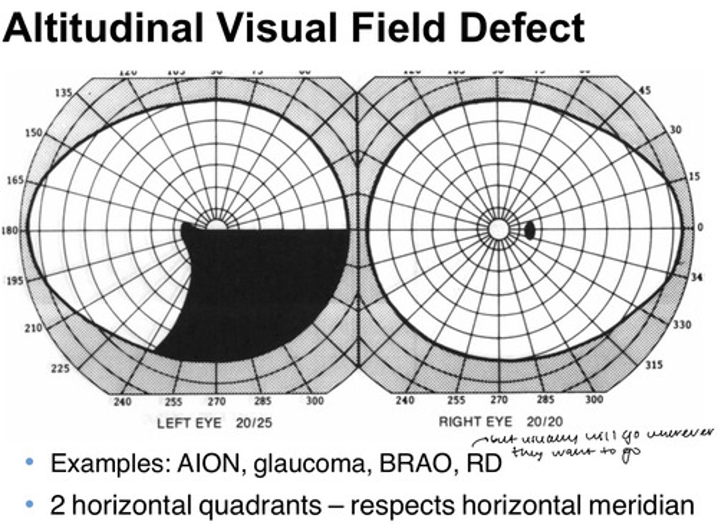 <p>C. Altitudinal Visual Field Defects</p><p>* Altitudinal defects occur in retinal vascular disease, glaucoma, and other disorders that affect the eye itself.</p>