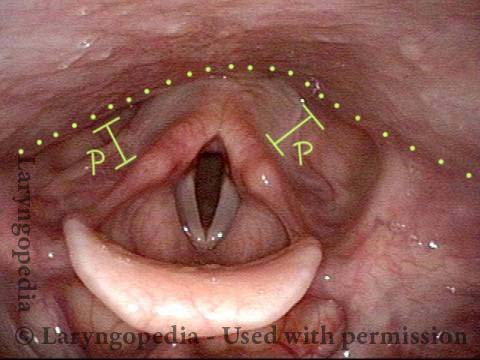 <p>Lateral to laryngeal outlet; Common place for sharp objects to get stuck (can still talk/breath) </p>