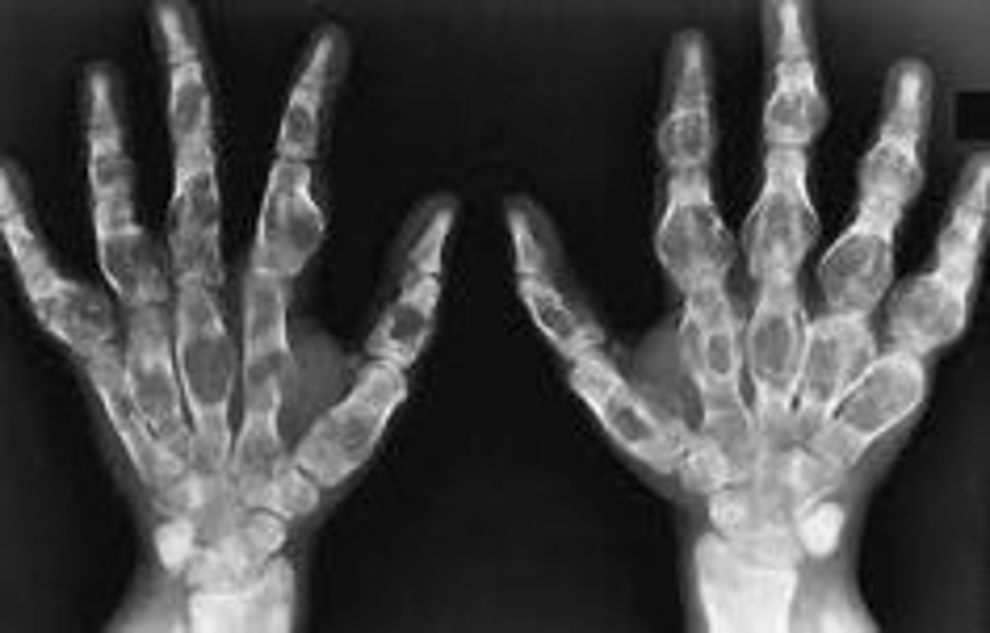 <p>Ollier's disease</p>