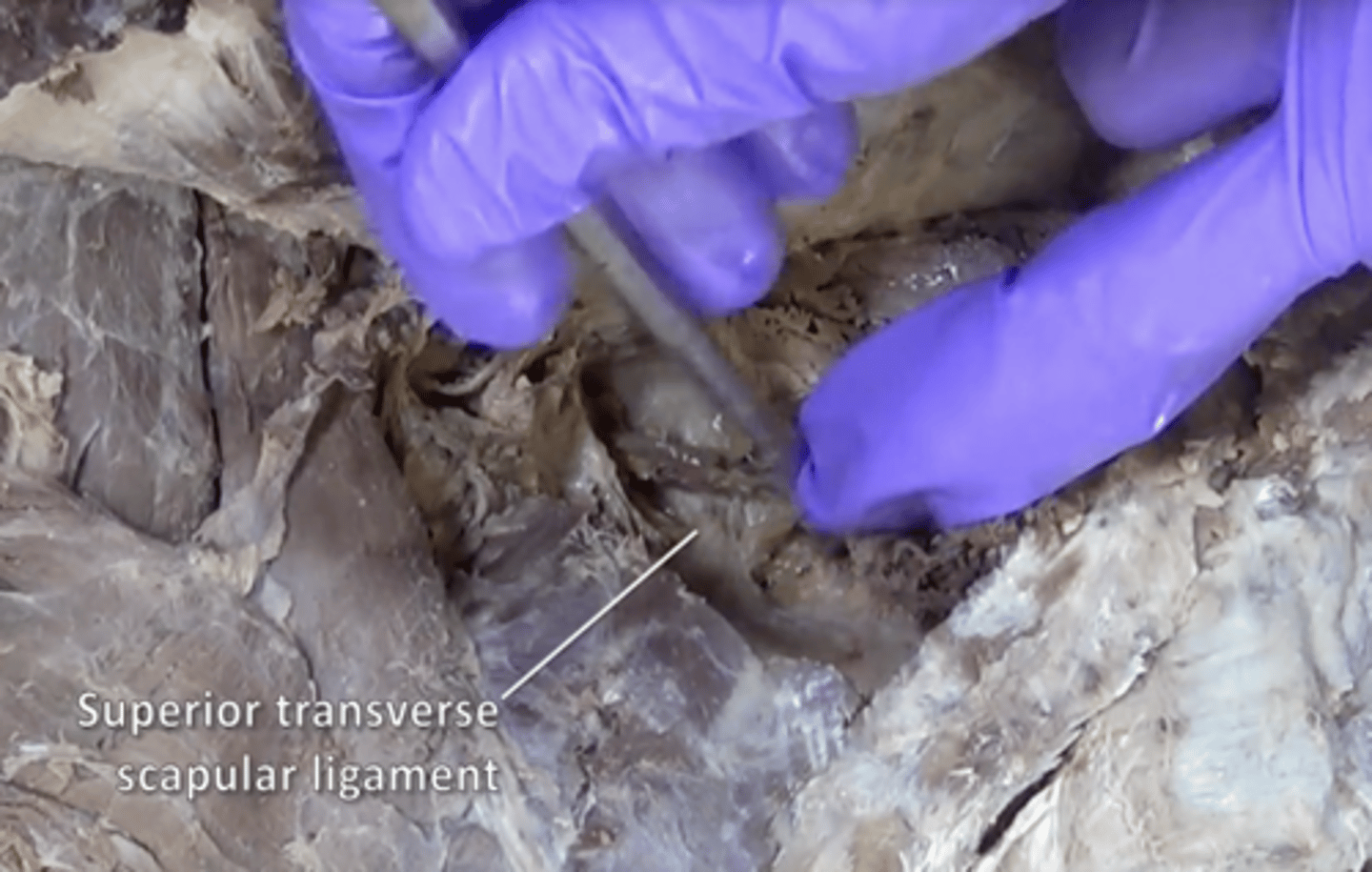 <p>bridges the scapular notch</p>