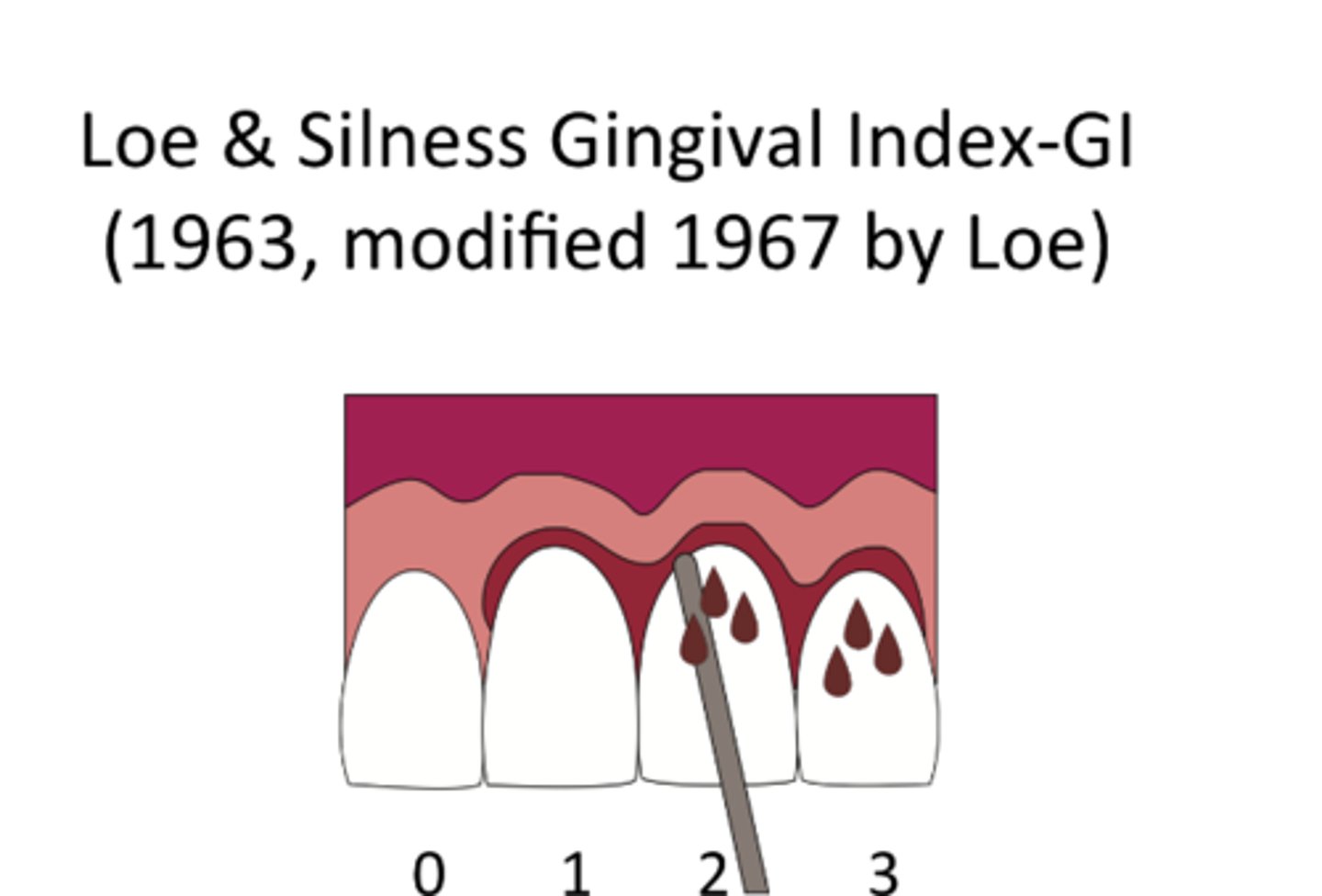 <p>it was developed in 1963 to measure the severity of gingival inflammation. it evaluates color, consistency, and bleeding of the gingival margin and gingivitis only</p>