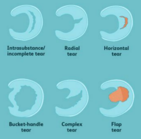 <p>Intrasubstance, radial, horizontal, complex tear, bucket-handle, and flap tear.</p>