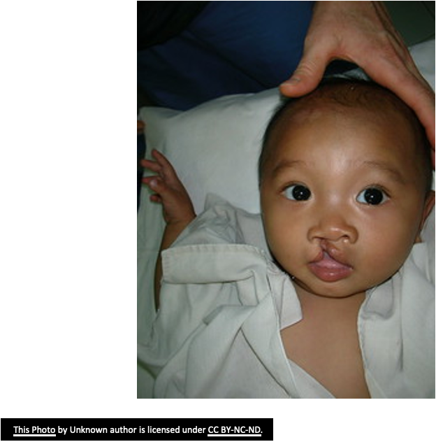 <p>cleft lip, cleft palate, and floppy infant syndrome</p>