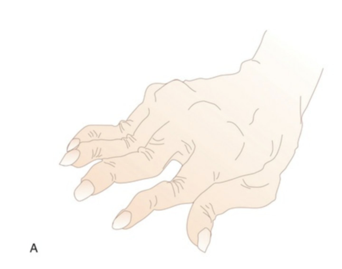 <p>swan neck deformity</p>