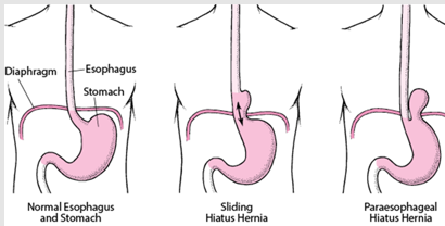 <p>hiatal hernia</p>