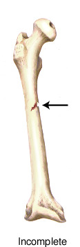<p>- greenstick</p><p>- Bone is still connected in someplace</p>