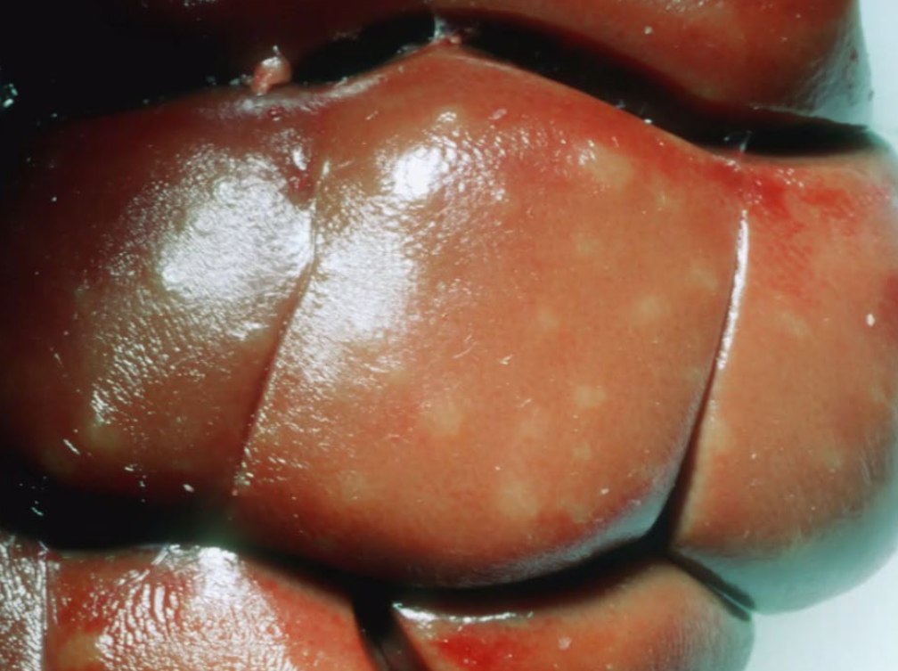 <p>What is a histologic change?</p><p>A-Interstitial nephritis</p><p>B-Glomerulonephritis</p><p>C-Tubulitis</p><p>D-Pyelonephritis</p>