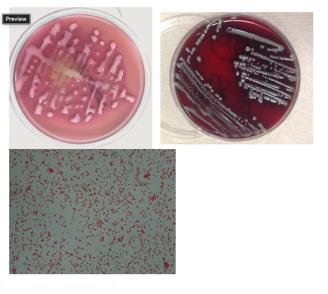 <p>Based on the growth and gram stain what is your next step in working up the urine culture?</p><p>&nbsp;</p><p>Perform a spot indole and if positive call it E. coli</p><p>&nbsp;</p><p>Set up an identification panel and susceptibility</p><p>This is an isolate that needs a full identification panel and susceptibility.</p><p>&nbsp;</p><p>Perform a catalase</p><p>&nbsp;</p><p>No work up, this is not a significant isolate</p>