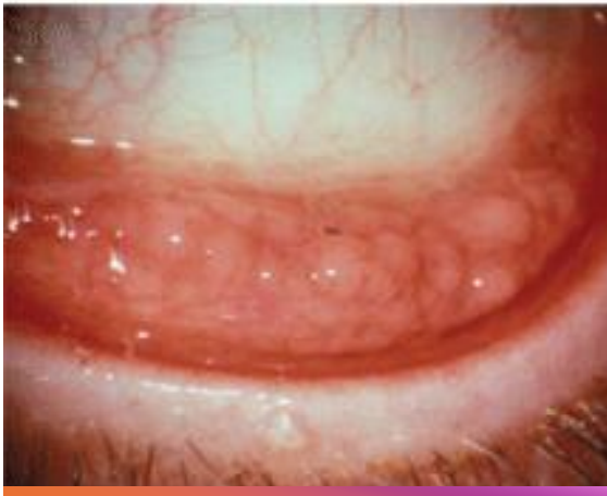 <ol><li><p><strong><u>oculo genital</u></strong> transmitted condition (<strong><u>HENCE subtypes D-K)</u></strong></p><ol><li><p>more typically unilateral</p></li><li><p>f<strong><u>ollicles/papillae on </u><mark data-color="yellow" style="background-color: yellow; color: inherit"><u>INFERIOR PALP CONJ</u></mark></strong></p></li><li><p>can exhibit keratitis w SEI</p></li></ol></li><li><p>can confirm w nucleic acid amplification test</p></li></ol><p></p>