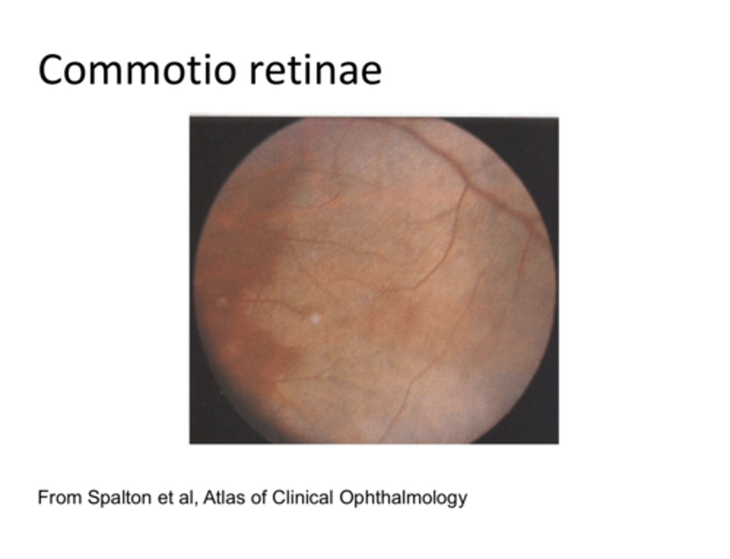 <p>What is commotio retinae?</p>