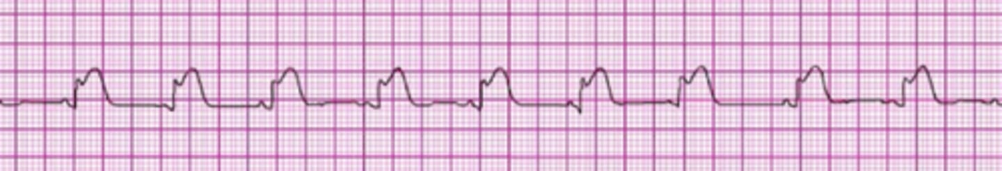 <p>Reperfusion therapy</p>