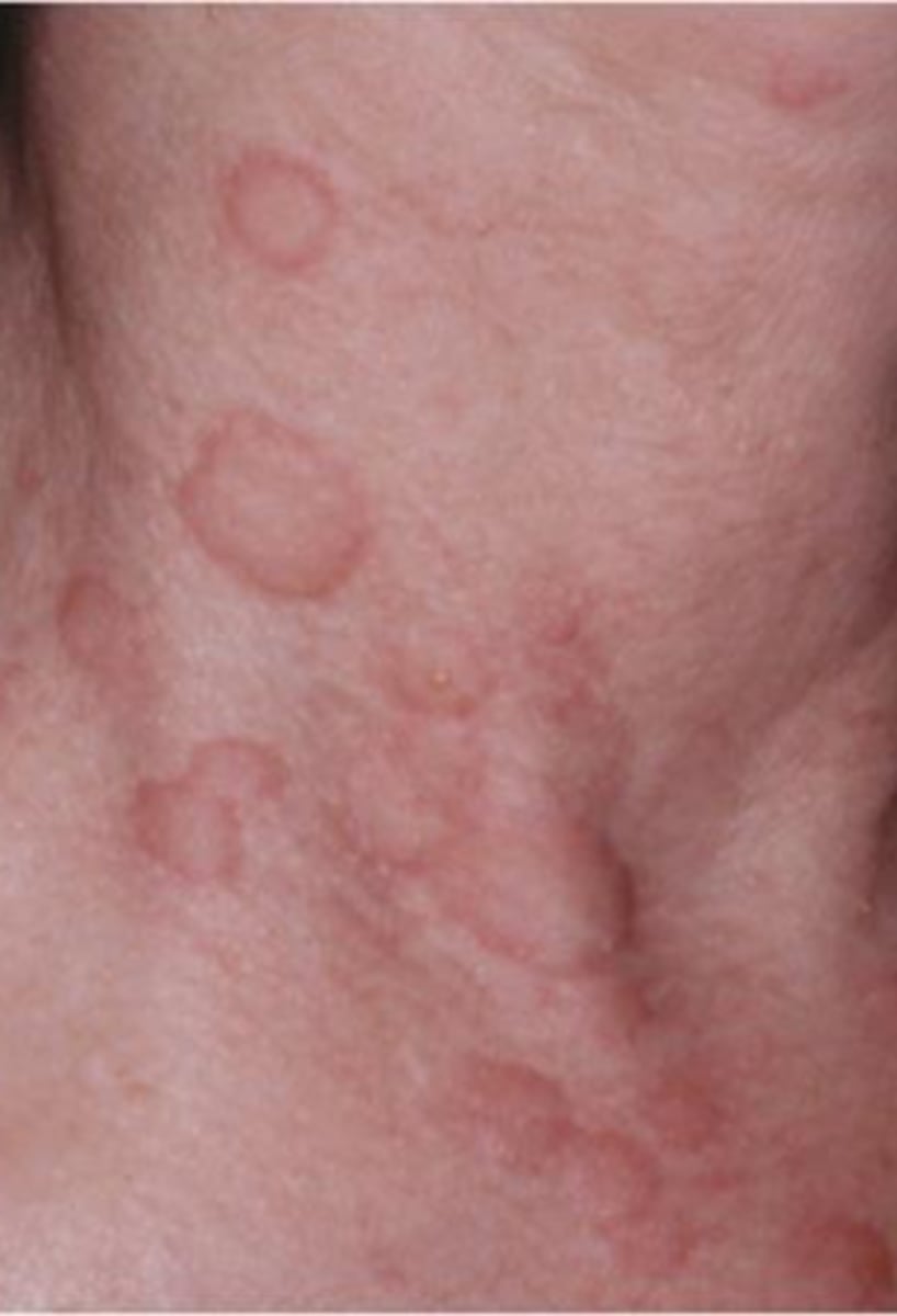 <p>_________________ (AKA: urticarial exanthem, urticaria)</p><p>- Rounded, or flat topped, edematous plaque</p><p>- Well demarcated</p><p>- No scaling</p><p>- No epidermal involvement</p><p>- Color varies</p><p>- Shape: round, oval, gyrate, annular or serpiginous</p>