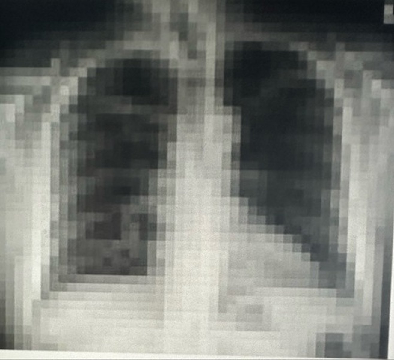 <p>• Matrix size</p><p>The image has a low spatial resolution as a result of a small matrix</p><p>size. Small matrix size results in fewer pixels that are larger,</p><p>resulting in a poor spatial resolution.</p>