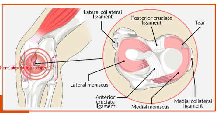 <p>Meniscus Tears: MOI</p><ul><li><p>6 main MOI</p></li></ul><p></p>