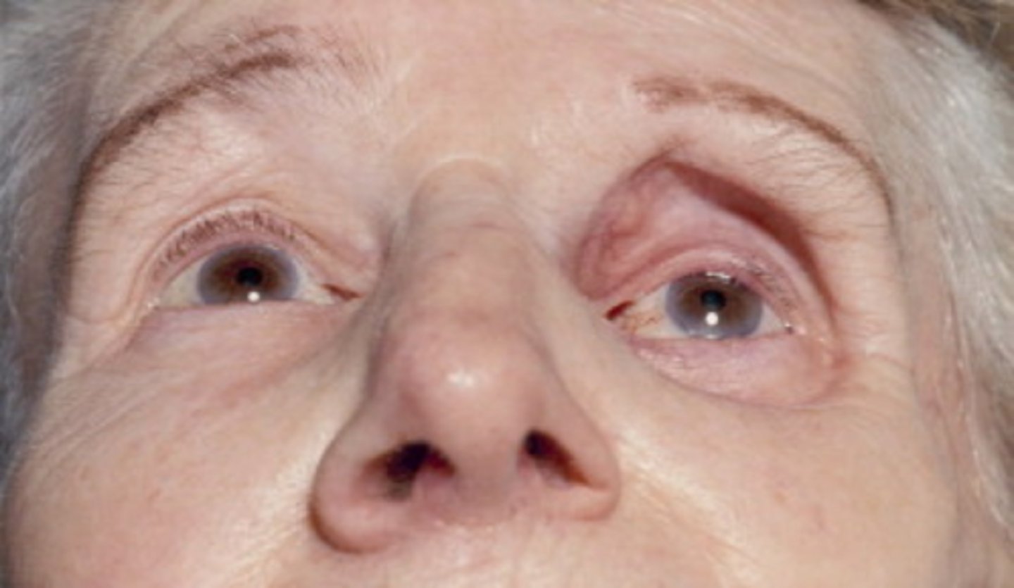 <p>enophthalmos*** → impaired ocular motility, diplopia, infraorbital hypesthesia</p>