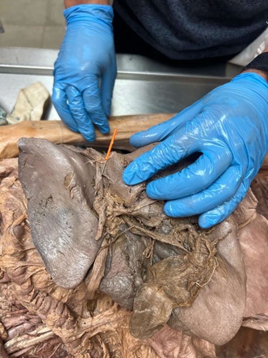 <p>ligamentum venosum</p>
