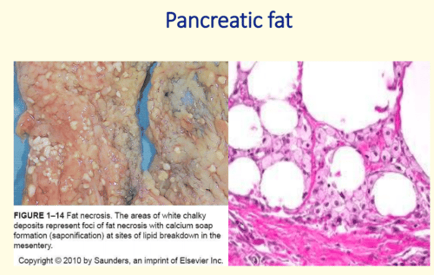 <p>Fat necrosis of the pancreas </p>